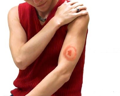 http://my-derma.com.ua/wp-content/uploads/2012/07/Herbal-Remedies-For-Lyme-Disease.jpg